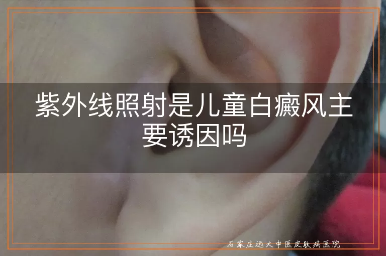 紫外线照射是儿童白癜风主要诱因吗