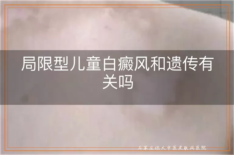 局限型儿童白癜风和遗传有关吗
