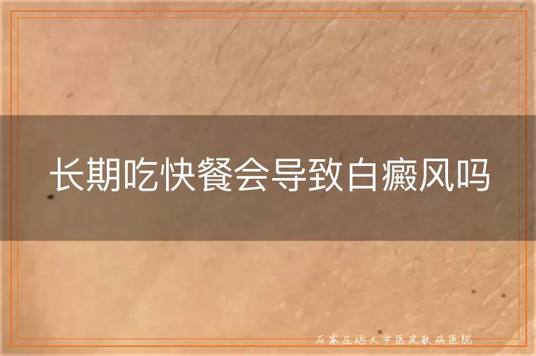 长期吃快餐会导致白癜风吗