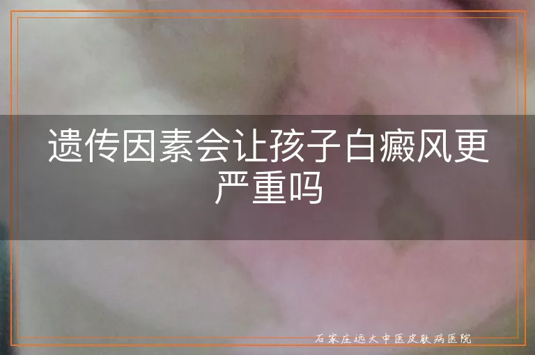 遗传因素会让孩子白癜风更严重吗