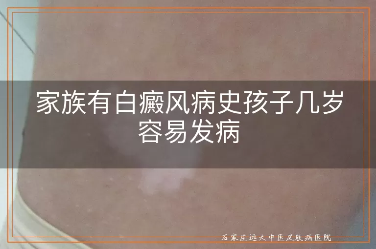 家族有白癜风病史孩子几岁容易发病