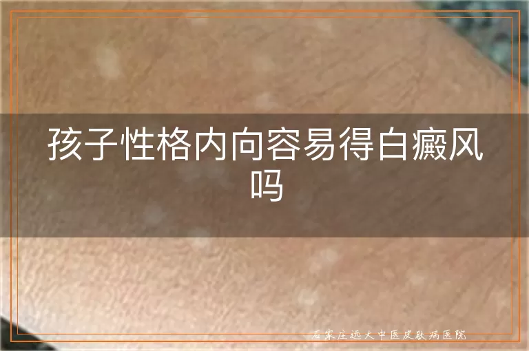 孩子性格内向容易得白癜风吗