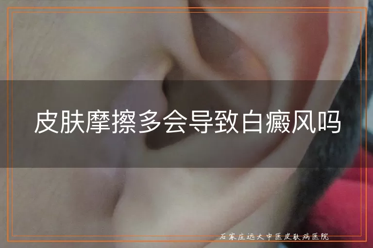 皮肤摩擦多会导致白癜风吗