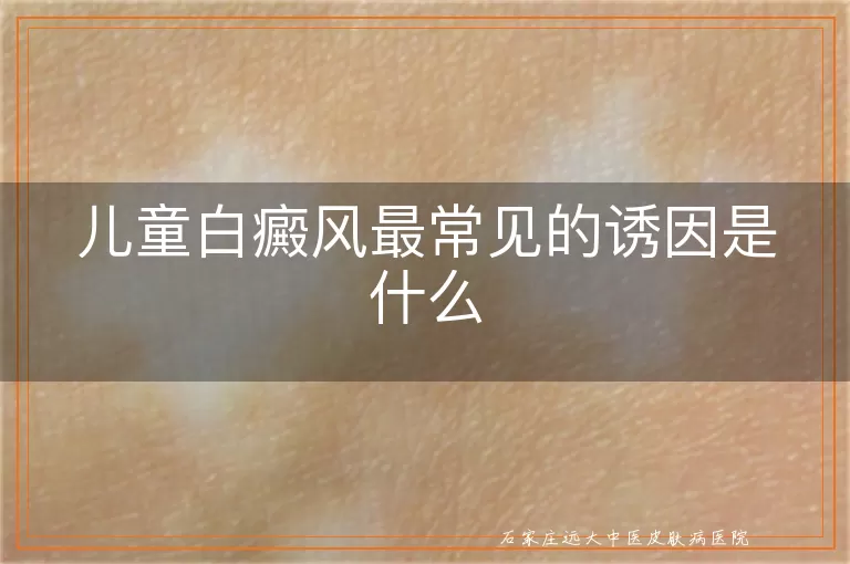 儿童白癜风最常见的诱因是什么
