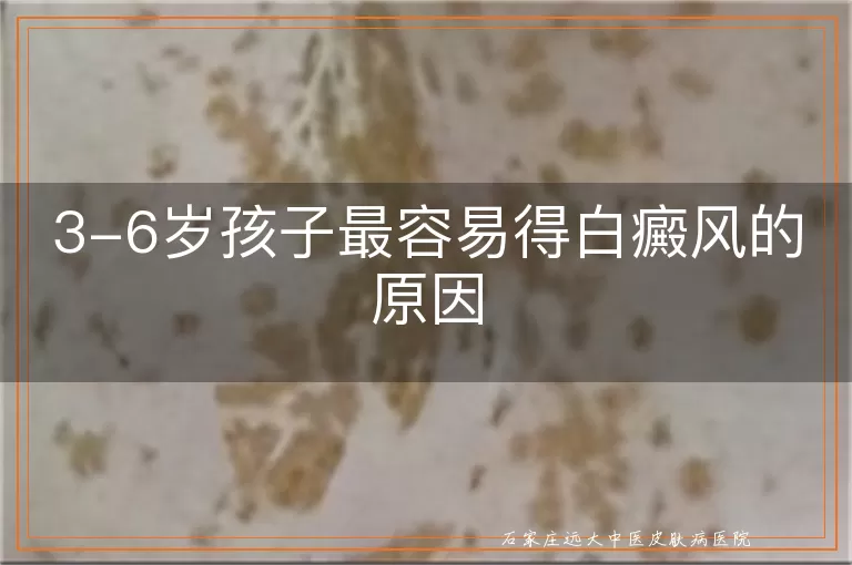 3-6岁孩子最容易得白癜风的原因