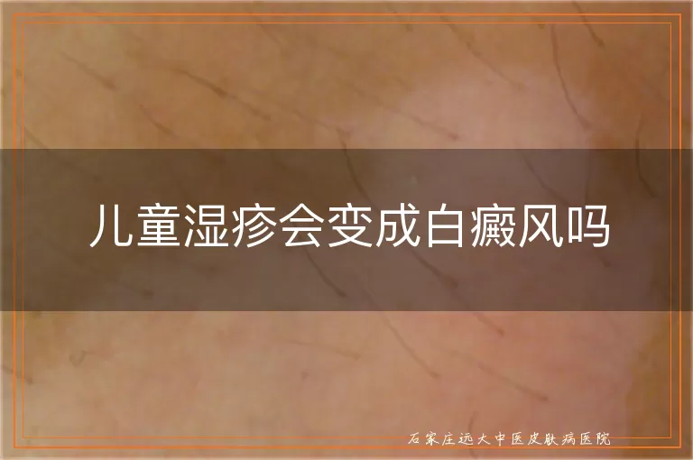 儿童湿疹会变成白癜风吗