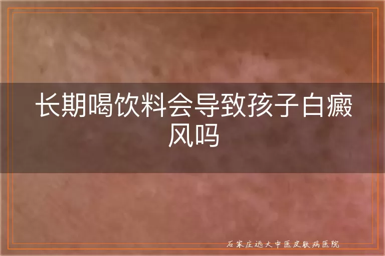 长期喝饮料会导致孩子白癜风吗
