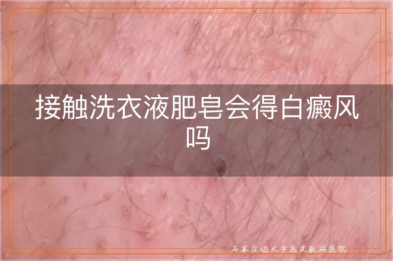 接触洗衣液肥皂会得白癜风吗