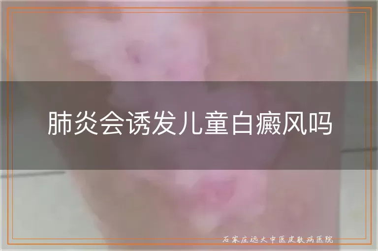 肺炎会诱发儿童白癜风吗
