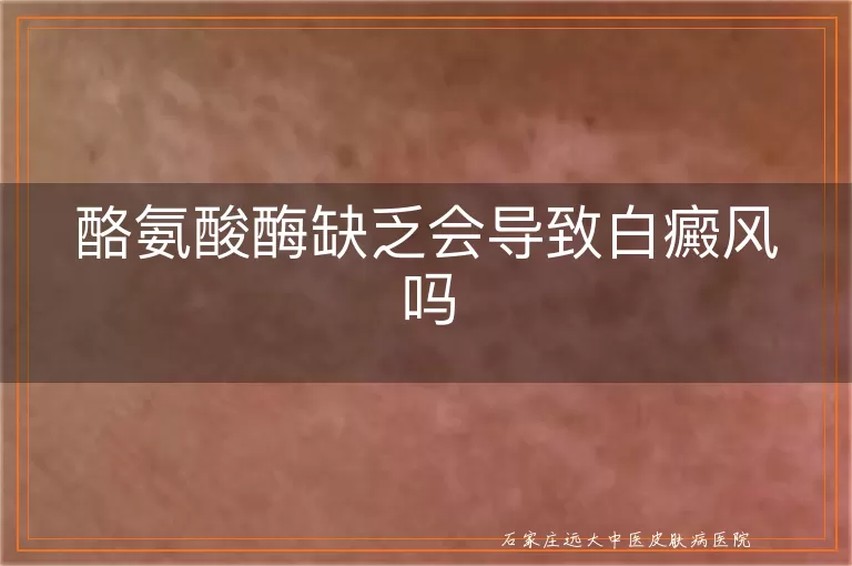 酪氨酸酶缺乏会导致白癜风吗
