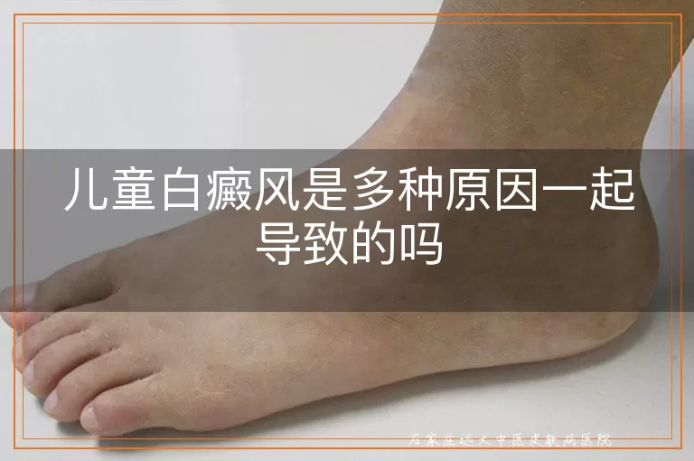 儿童白癜风是多种原因一起导致的吗