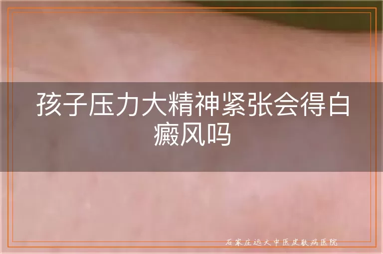 孩子压力大精神紧张会得白癜风吗