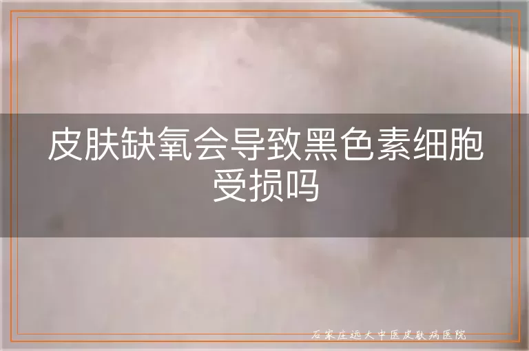 皮肤缺氧会导致黑色素细胞受损吗