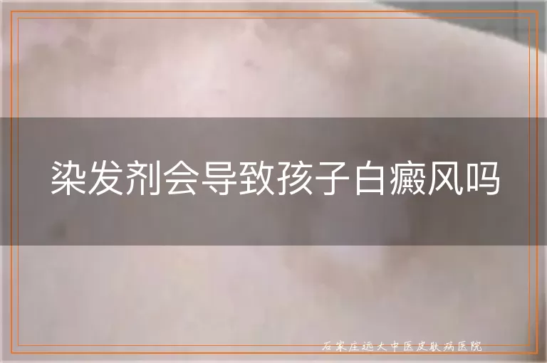 染发剂会导致孩子白癜风吗