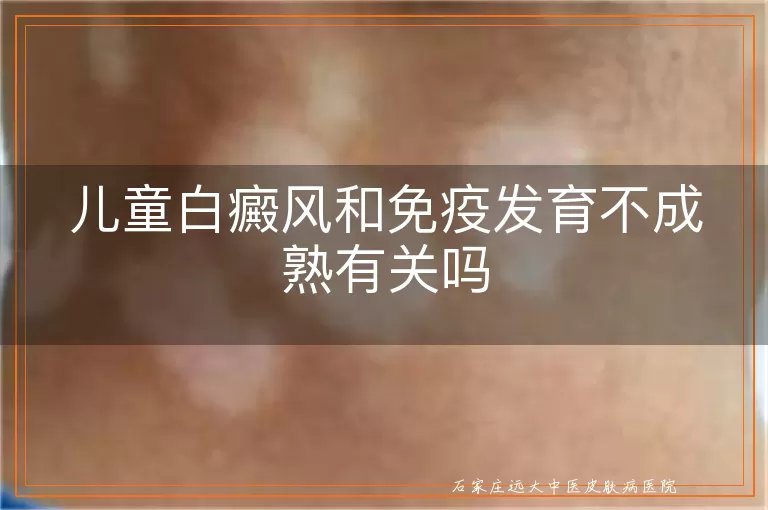 儿童白癜风和免疫发育不成熟有关吗