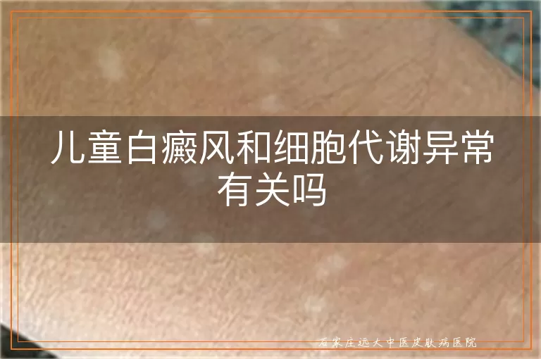 儿童白癜风和细胞代谢异常有关吗