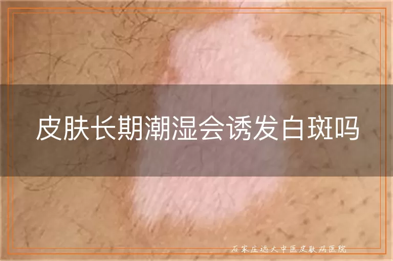 皮肤长期潮湿会诱发白斑吗