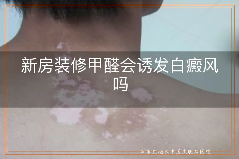 新房装修甲醛会诱发白癜风吗