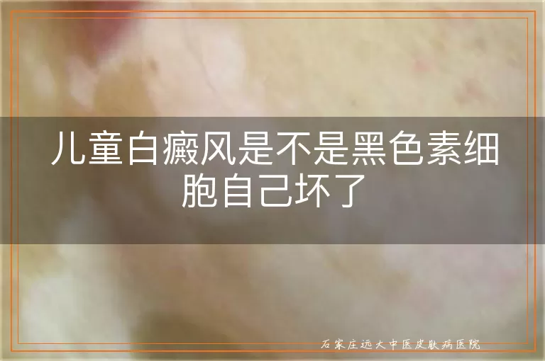 儿童白癜风是不是黑色素细胞自己坏了