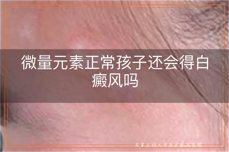 微量元素正常孩子还会得白癜风吗