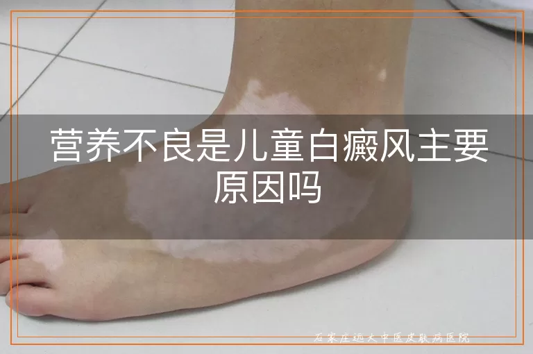 营养不良是儿童白癜风主要原因吗