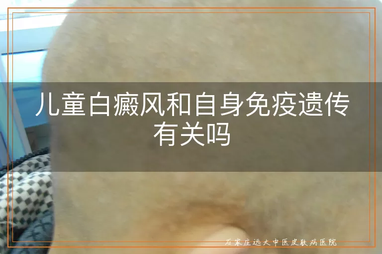 儿童白癜风和自身免疫遗传有关吗