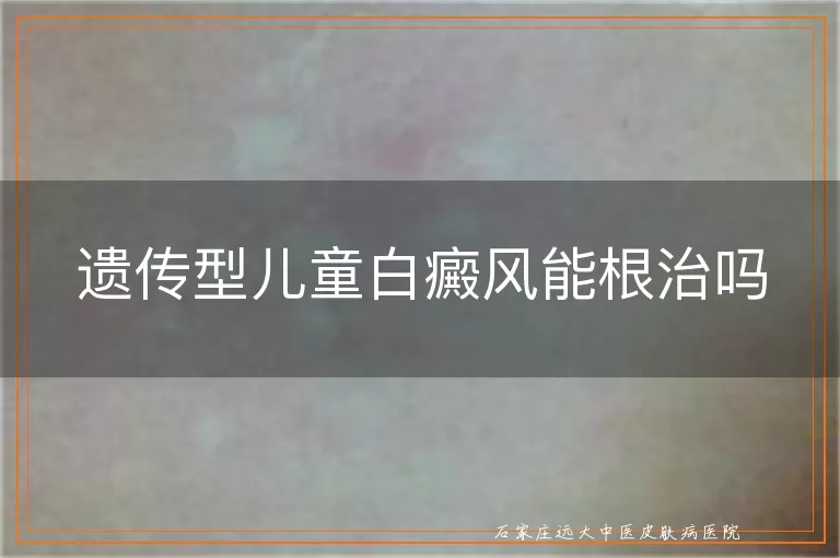 遗传型儿童白癜风能根治吗