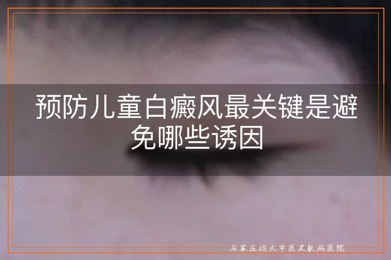 预防儿童白癜风最关键是避免哪些诱因
