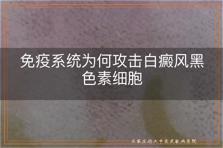 免疫系统为何攻击白癜风黑色素细胞