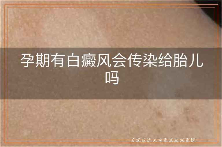 孕期有白癜风会传染给胎儿吗