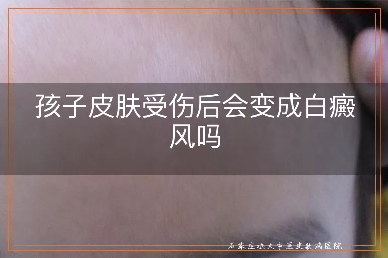 孩子皮肤受伤后会变成白癜风吗