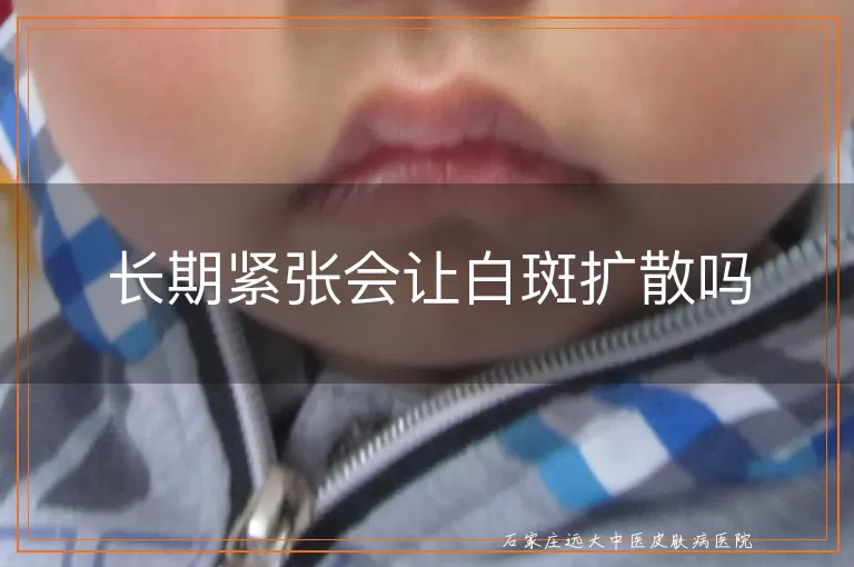 长期紧张会让白斑扩散吗