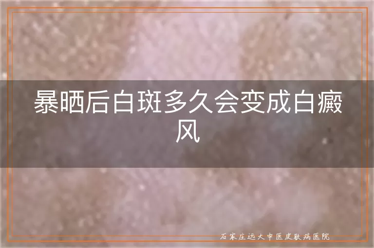 暴晒后白斑多久会变成白癜风