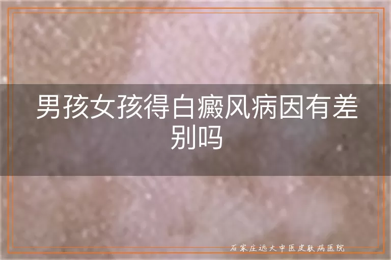 男孩女孩得白癜风病因有差别吗