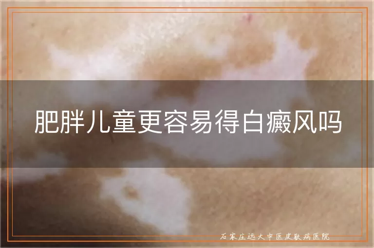 肥胖儿童更容易得白癜风吗