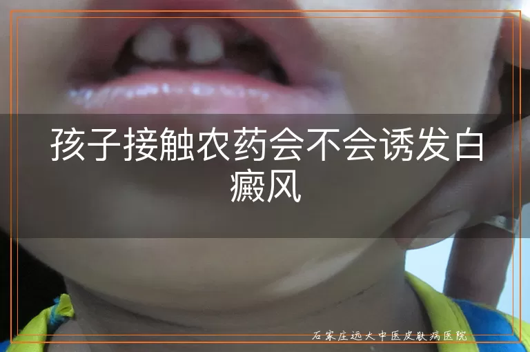 孩子接触农药会不会诱发白癜风