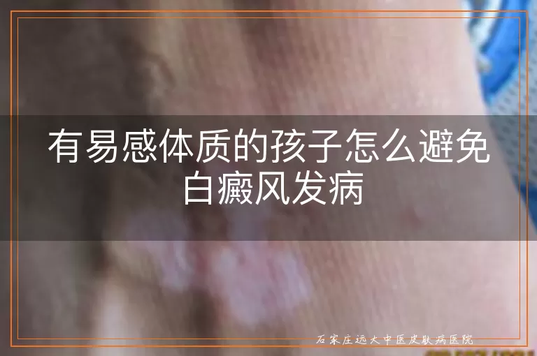 有易感体质的孩子怎么避免白癜风发病