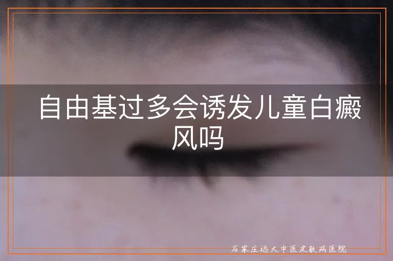 自由基过多会诱发儿童白癜风吗