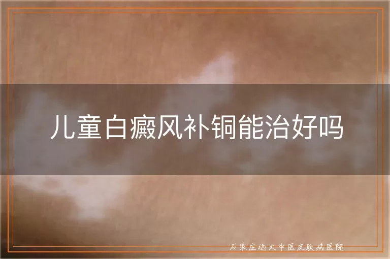 儿童白癜风补铜能治好吗