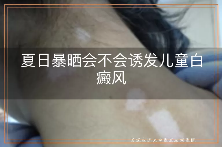 夏日暴晒会不会诱发儿童白癜风