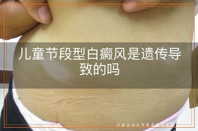 儿童节段型白癜风是遗传导致的吗
