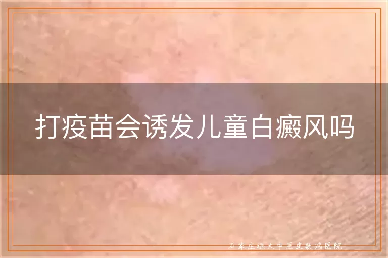 打疫苗会诱发儿童白癜风吗