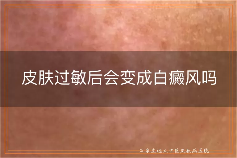 皮肤过敏后会变成白癜风吗