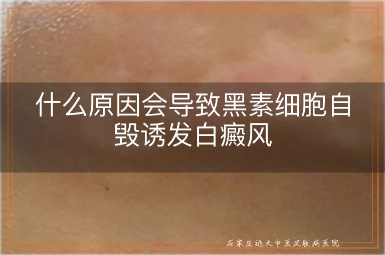 什么原因会导致黑素细胞自毁诱发白癜风