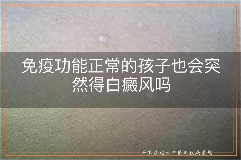 免疫功能正常的孩子也会突然得白癜风吗