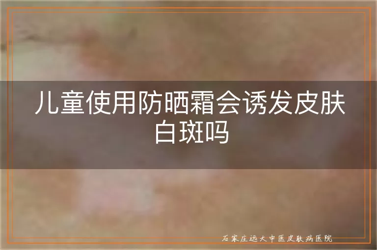 儿童使用防晒霜会诱发皮肤白斑吗