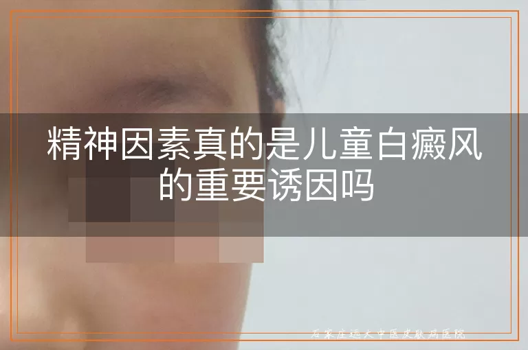 精神因素真的是儿童白癜风的重要诱因吗