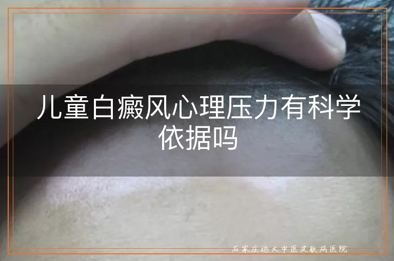 儿童白癜风心理压力有科学依据吗