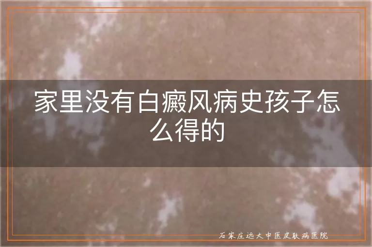 家里没有白癜风病史孩子怎么得的