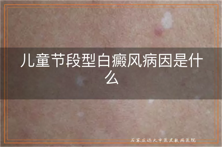 儿童节段型白癜风病因是什么